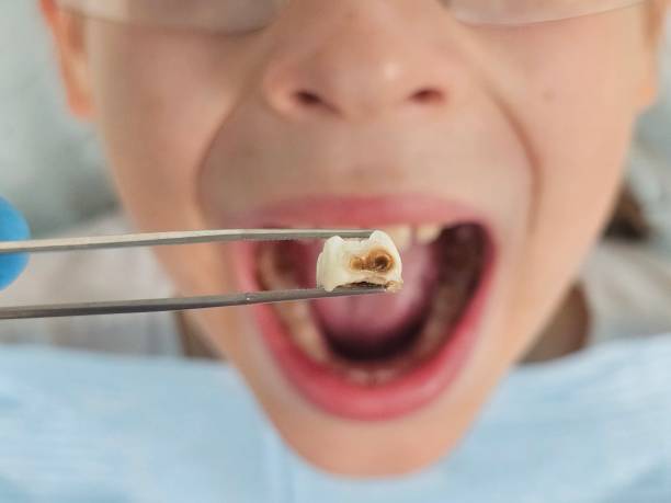 Best Emergency Tooth Extraction in Prairie Du Chien, WI